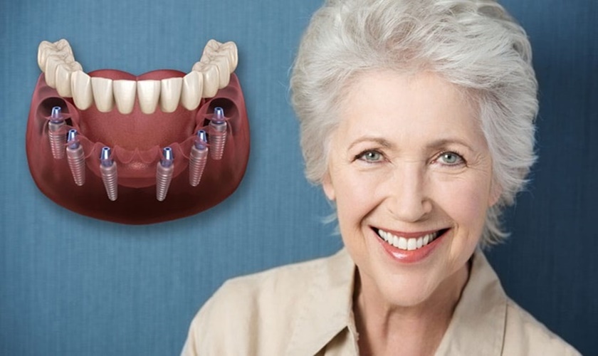 Cấy ghép răng implant Nobel Active Mỹ mang lại nụ cười chân thật không khách gì răng thật