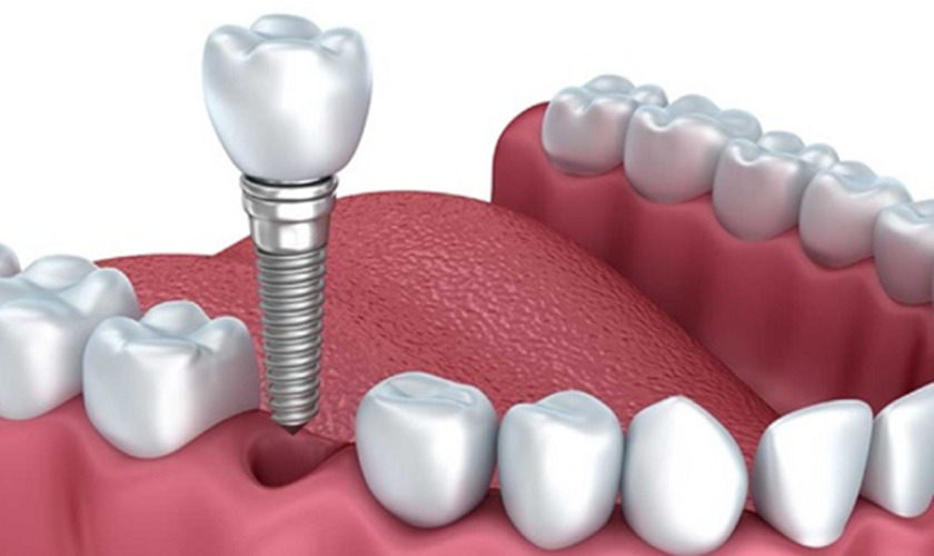 Trụ implant Nobel Mỹ có khả năng tích hợp xương cao và thay thế hầu như hoàn toàn chức năng răng thật