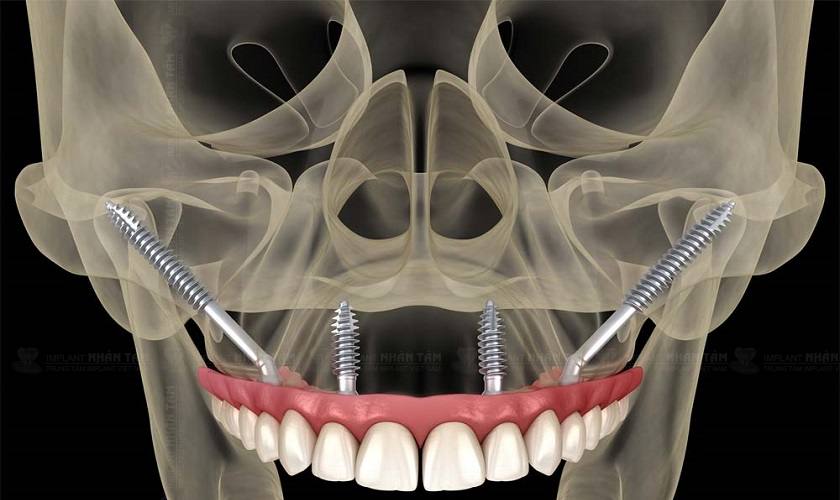 Phương pháp cấy ghép Implant xương gò má sử dụng 2-4 trụ Implant dài cấy vào vùng xương gò má theo góc nghiêng