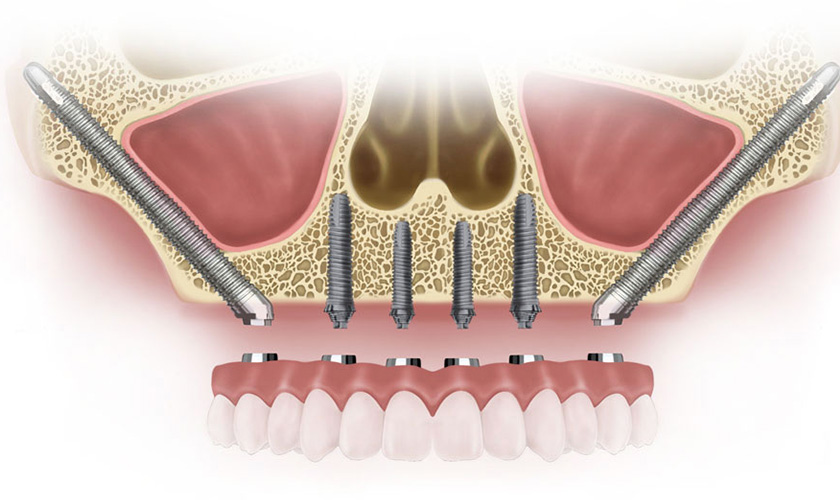 Implant xương gò má cho phép hạn chế các kỹ thuật nâng xoang, ghép xương, giảm số lần phẫu thuật và giảm thiểu tối đa sang chấn