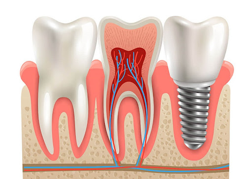 Kỹ thuật trồng răng Implant giúp khôi phục toàn diện răng đã mất