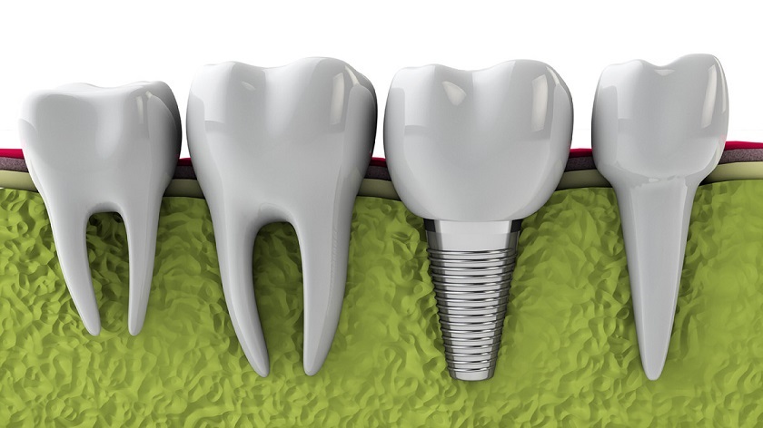 Răng implant có độ bền cao