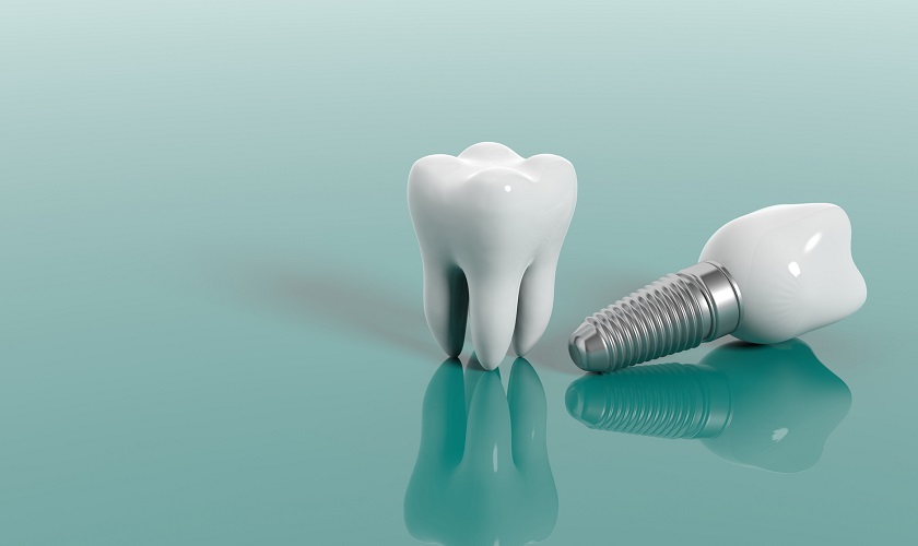Bảng giá trồng răng implant trọn gói mới nhất