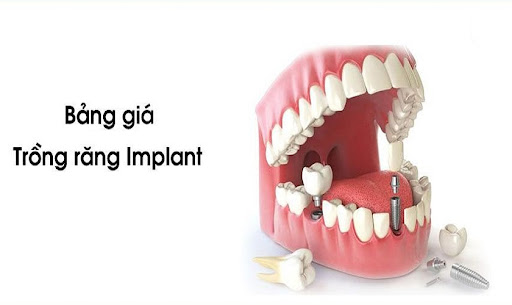 Bảng giá trồng răng Implant và một số thông tin liên quan