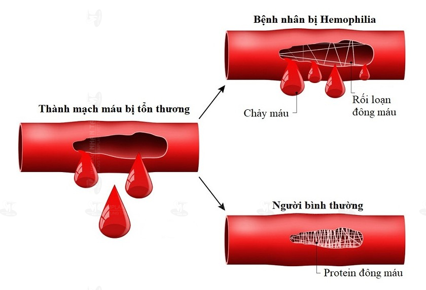 Bệnh máu không đông là tình trạng rối loạn đông máu khiến máu khó đông lại như bình thường