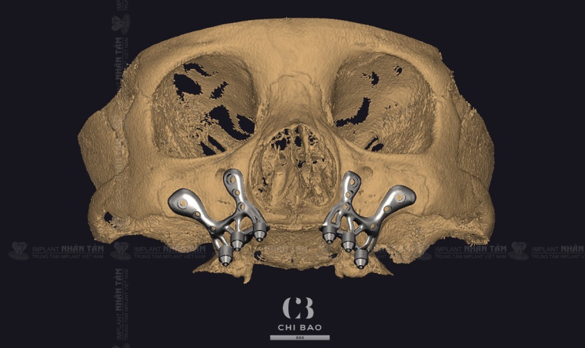 Kỹ thuật cấy ghép răng Implant cá nhân hóa giúp giảm thiểu tối đa xâm lấn, hạn chế chảy máu