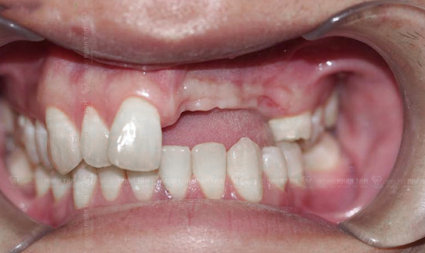 Bị mất nhiều răng phải làm sao?