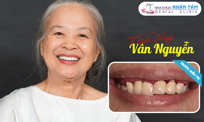 Khách hàng bị viêm nha chu phải nhổ răng và trồng răng Implant