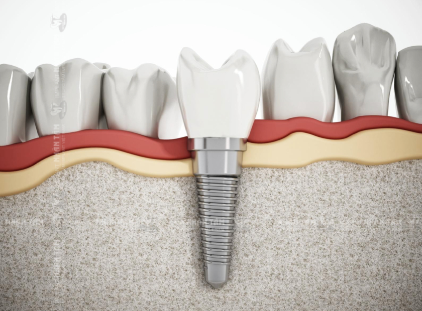 Răng Implant được cấy vào xương hàm như răng thật