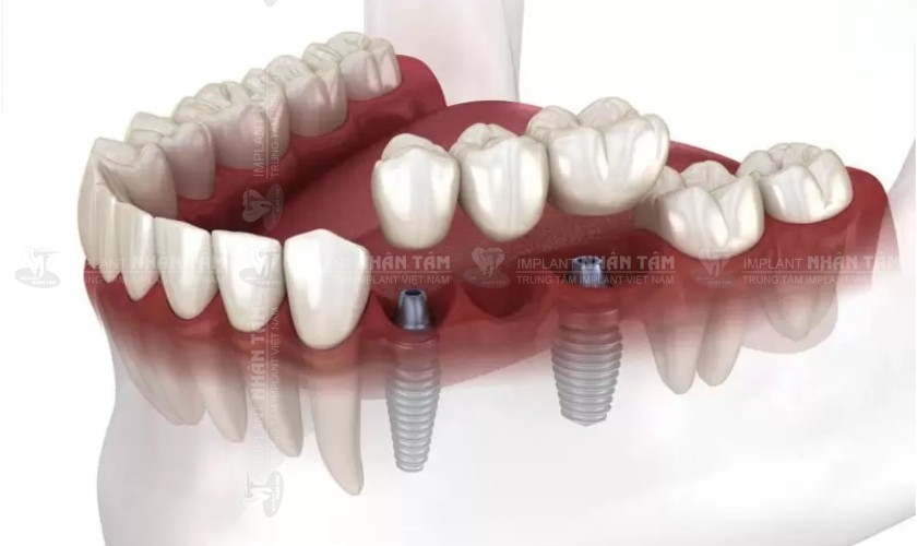 Cầu răng được hỗ trợ bằng Implant