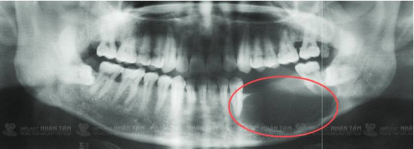 Xương hàm tại vị trí mất răng qua phim CT Cone Beam 3D