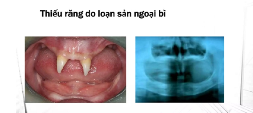 Bệnh nhân không răng bẩm sinh do hội chứng loạn sản ngoại bì bị tiêu xương trầm trọng, gần như không có xương hàm