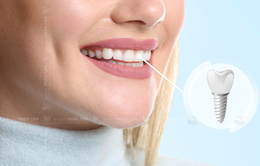 Trồng răng Implant được đánh giá là giải pháp phục hình răng cửa toàn diện