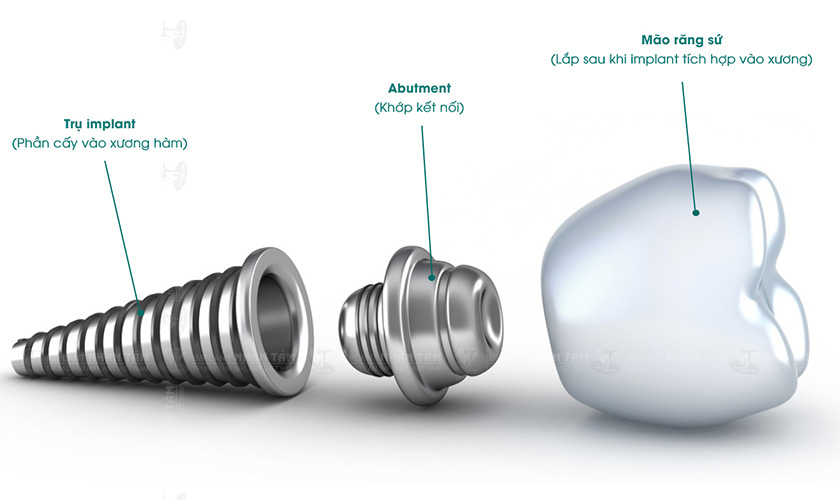 Cấu tạo răng Implant tương đồng với răng thật, giúp ngăn ngừa tiêu xương, mang lại khả năng ăn nhai và thẩm mỹ tuyệt đối