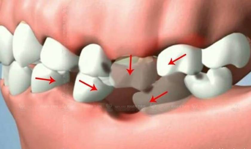 Bị mất răng số 6 có ảnh hưởng gì không?