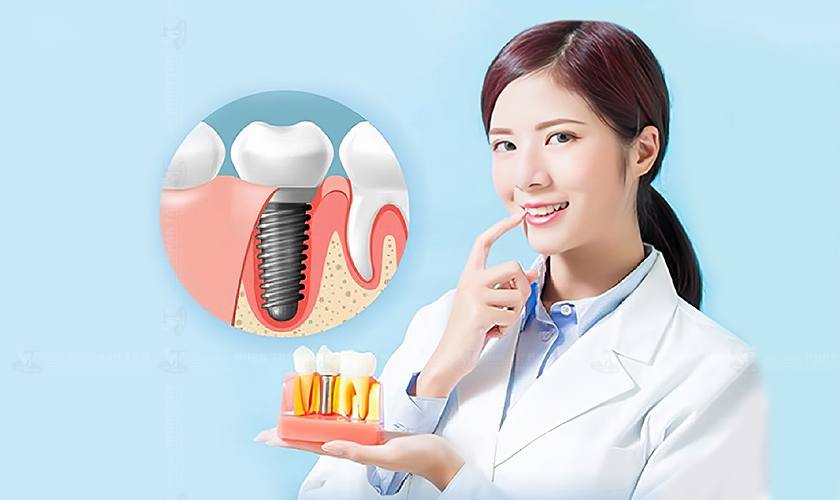 Răng Implant sở hữu nhiều ưu điểm vượt trội