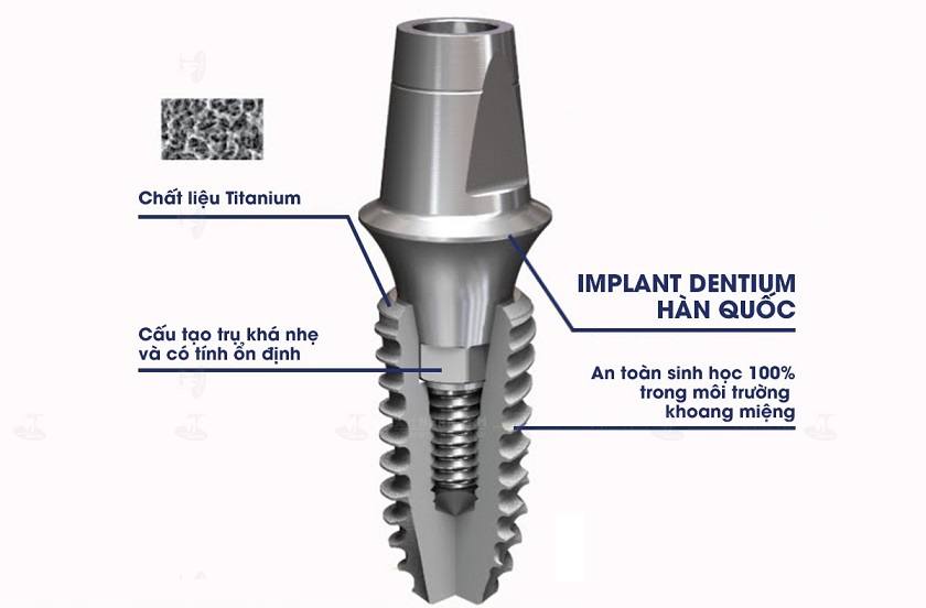 Implant Dentium Hàn Quốc được các chuyên gia đánh giá cao về chất lượng, an toàn và lành tính với cơ thể