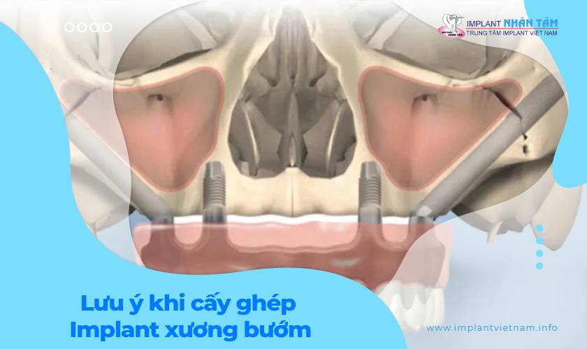 Cấy ghép Implant xương bướm - Bệnh nhân cần lưu ý gì?