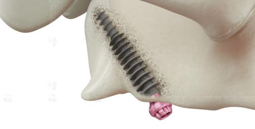 Do gần khoang xoang, việc cấy ghép Implant xương cánh bướm sai kỹ thuật có thể dẫn đến biến chứng xoang