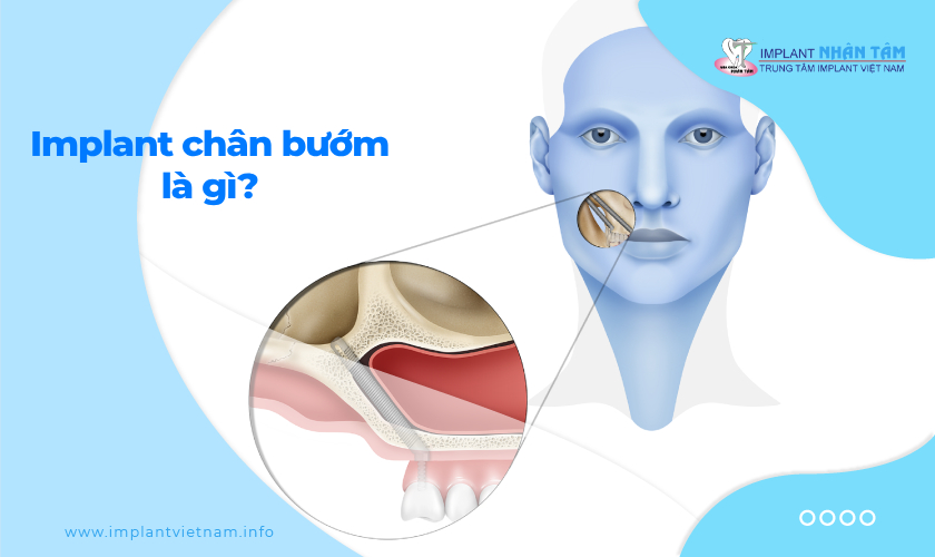 Cấy ghép Implant xương bướm – Implant chân bướm là gì?