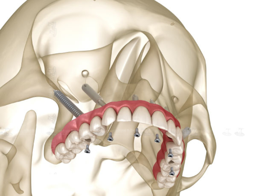 Cấy ghép Implant xương bướm được xem là giải pháp “cứu cánh” cho bệnh nhân bị tiêu xương trầm trọng ở khu vực răng sau hàm trên