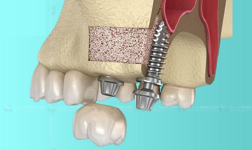 Kỹ thuật nâng xoang trong cấy ghép Implant truyền thống