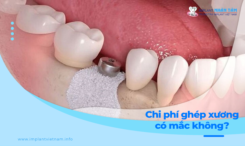 Cấy ghép xương để cắm Implant có mắc không?