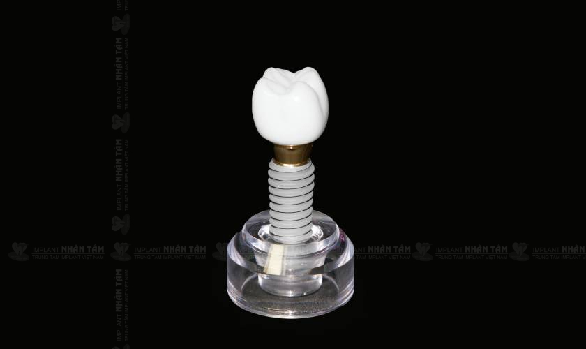 Trồng răng Implant là giải pháp điều trị mất răng hiệu quả nhất hiện nay