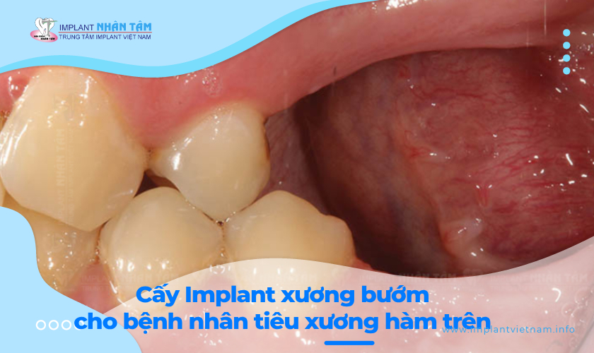 Cấy Implant xương bướm cho bệnh nhân bị tiêu xương hàm trên