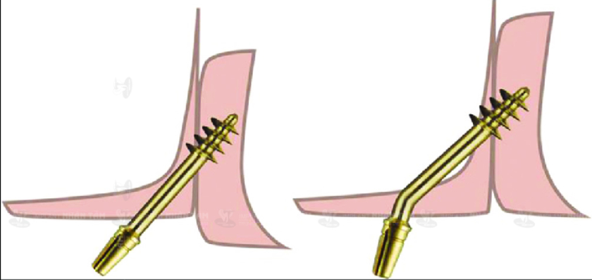 Độ dài và thiết kế Implant xương bướm sẽ phụ thuộc vào cấu trúc giải phẫu của bệnh nhân