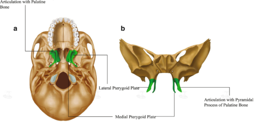 Vùng xương bướm cung cấp vị trí tuyệt vời để nâng đỡ trụ Implant trong trường hợp xương hàm trên bị tiêu trầm trọng