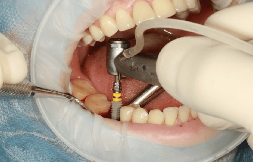 Kỹ thuật cấy răng implant có thể tiến hành ngay sau khi mất răng