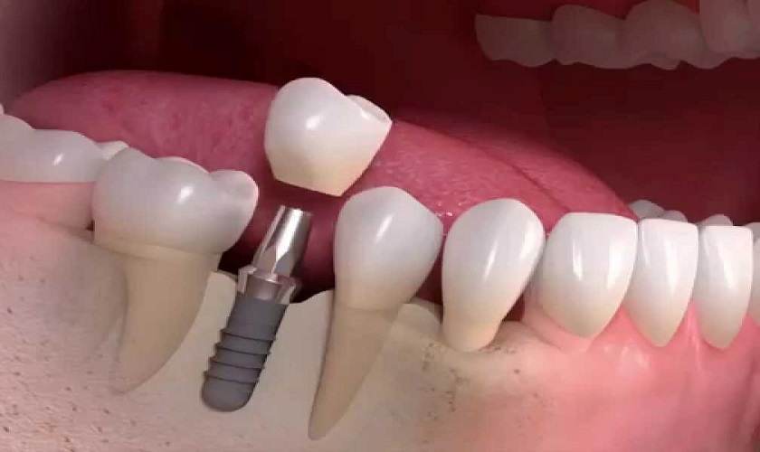 Có thể cấy răng Implant tức thì sau khi mất răng không?