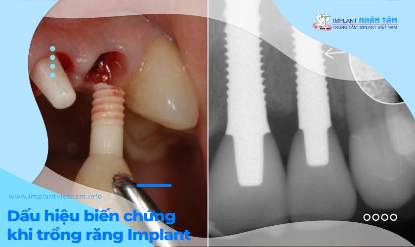 Dấu hiệu bệnh nhân đang bị biến chứng khi trồng răng Implant