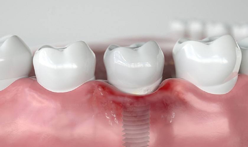 Nhiễm trùng khi cấy ghép Implant là một biến chứng nguy hiểm với những biểu hiện như sưng đau, chảy máu kéo dài tại vị trí cấy ghép