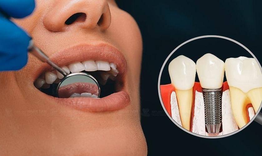 Tổn thương dây thần kinh thường do Bác sĩ đặt Implant vị trí quá sâu