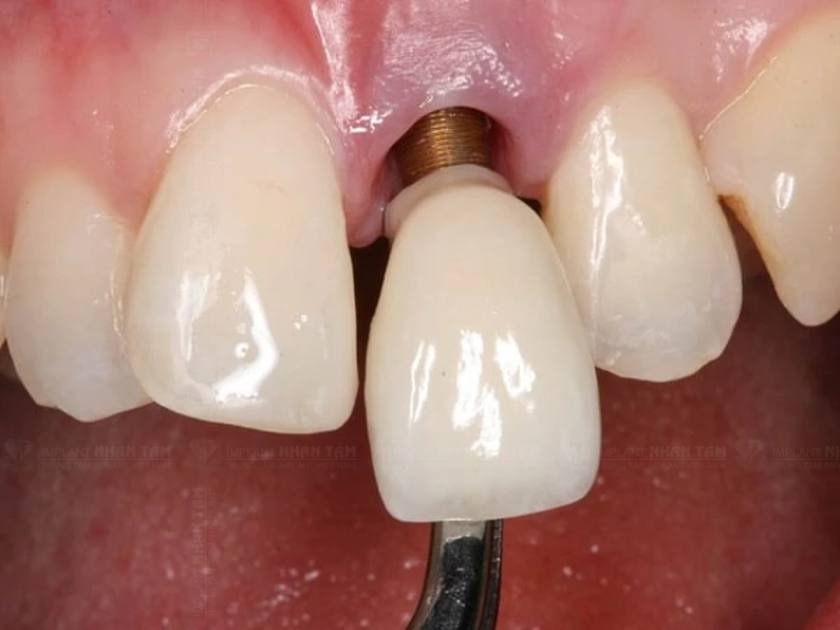 Trụ Implant bị đào thải