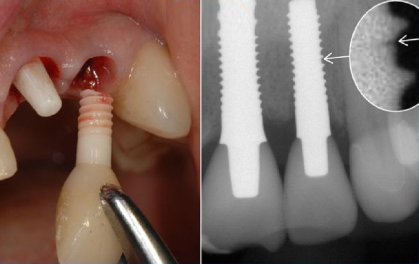 Sưng tấy và đau nhức, chảy máu kéo dài là biểu hiện đầu tiên của biến chứng khi trồng răng Implant