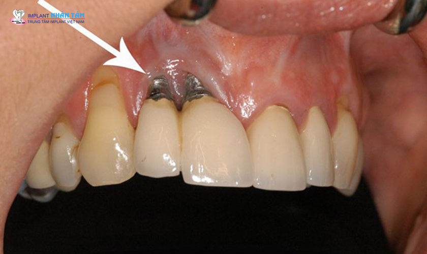 Trụ Implant có dấu hiệu lung lay và bị đào thải