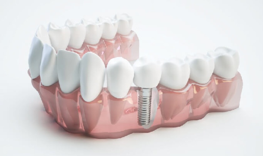 Điểm mặt những rủi ro khi cấy ghép răng implant