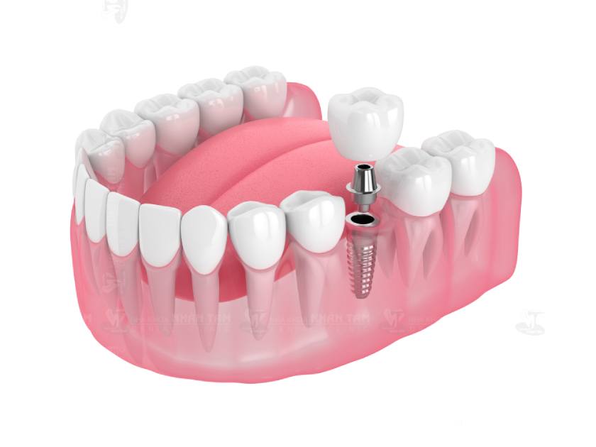 Trồng răng Implant sử dụng trụ Implant được chế tác từ Titanium cấy trực tiếp vào xương hàm nhằm thay thế chân răng bị mất