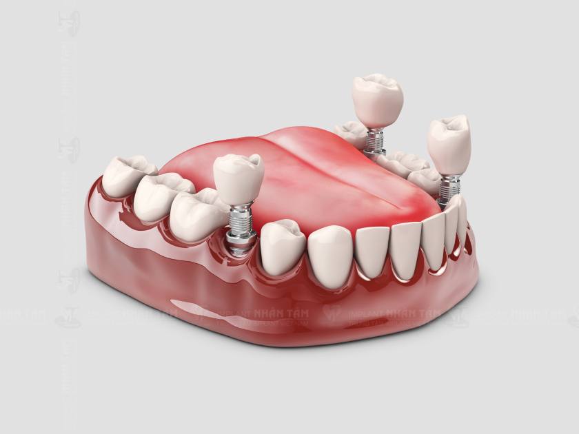 Trồng răng Implant mang lại hiệu quả tối ưu về chức năng ăn nhai, thẩm mỹ và phòng ngừa tiêu xương hàm