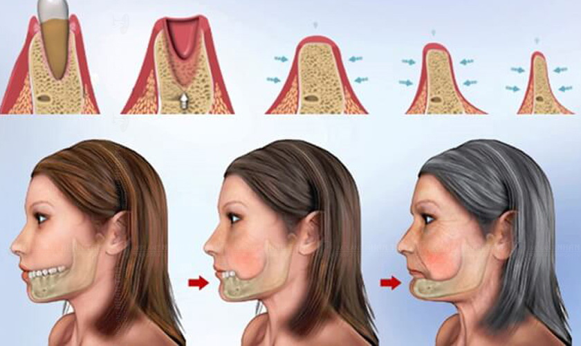 Tiêu xương hàm là hậu quả nghiêm trọng do mất răng gây ra