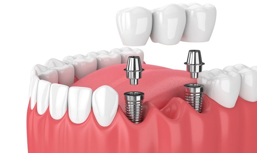Giá trồng răng implant bao nhiêu? Dành cho đối tượng nào