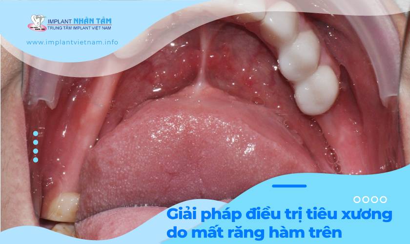 Giải pháp điều trị tiêu xương hàm trên do mất răng