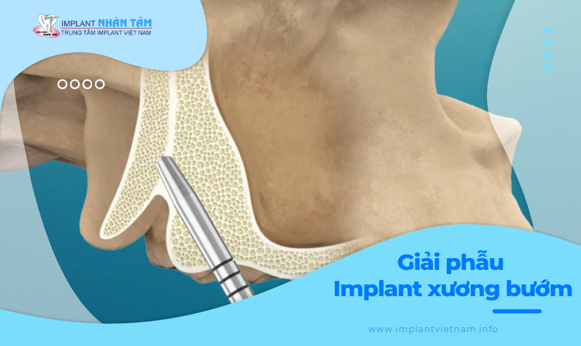  Giải phẫu của Implant xương bướm