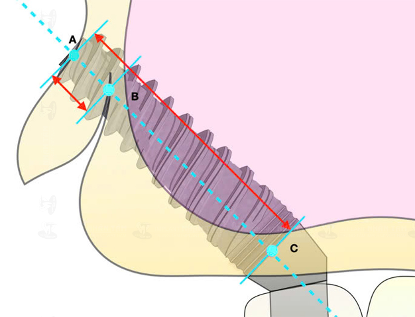 Implant xương bướm có chiều dài dài hơn trụ Implant thông thường và được đặt vào xương cánh bướm theo góc nghiêng