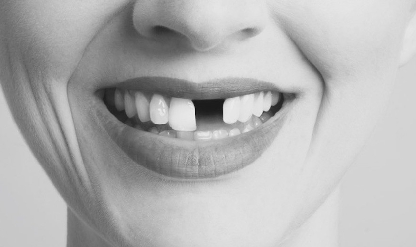 Hậu quả mất răng ảnh hưởng như thế nào