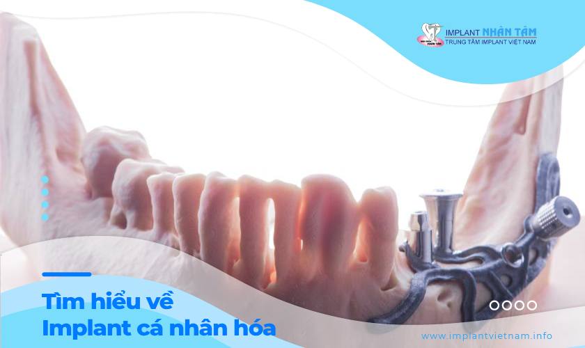  Implant cá nhân hóa là gì? Những điều cần biết