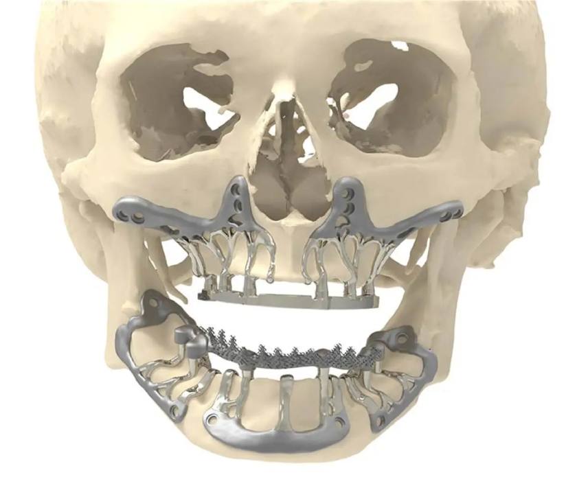 Quá trình cấy ghép Implant cá nhân hóa ít xâm lấn hơn, giảm thiểu cảm giác đau nhức, sưng tấy cho khách hàng, đồng thời đẩy nhanh tốc độ hồi phục